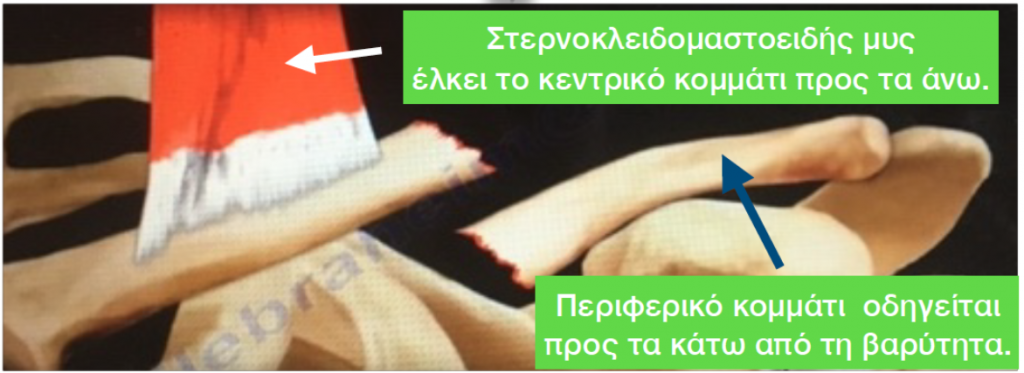Κάταγμα κλείδας σε παιδιά: Φαίνεται η παρεκτόπιση των οστικών τεμαχίων.
