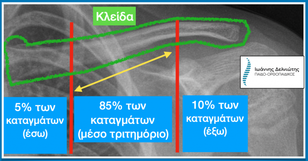 Κάταγμα κλείδας σε παιδιά: Ποσοστό καταγμάτων ανάλογα με το τριτημόριο της κλείδας.
Τα περισσότερα κατάγματα θα εμφανιστούν στο μέσο τριτημόριο
