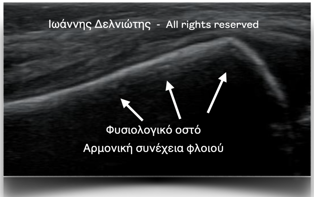 Υπέρηχος σε παιδί μετά από κάκωση του αγκώνα.