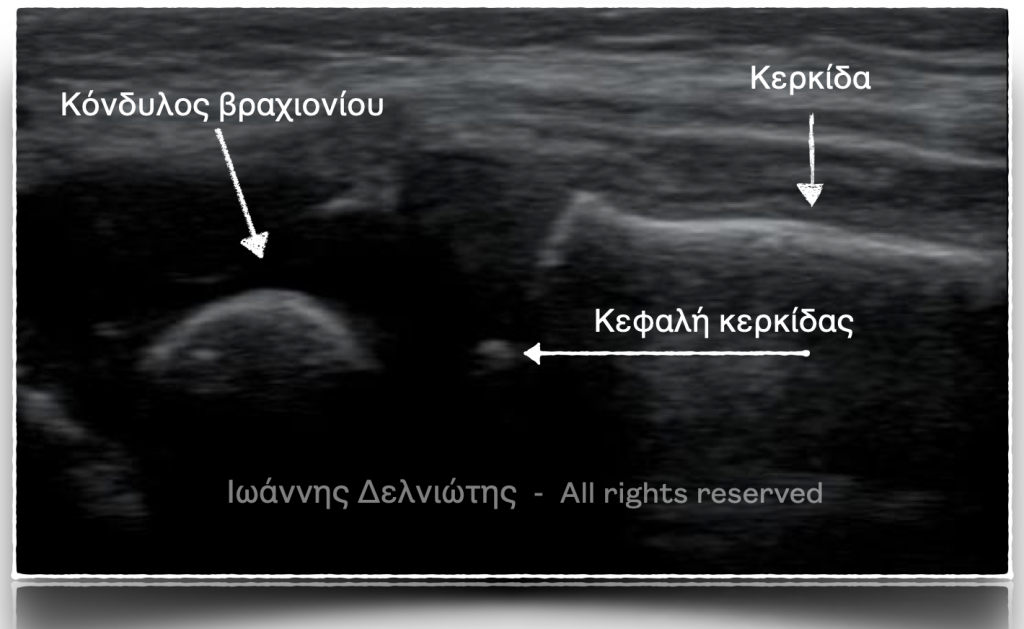 Διάγνωση παιδιατρικών καταγμάτων με υπέρηχο. Ανατομική ταυτοποίηση των οστών στην άρθρωση του αγκώνα