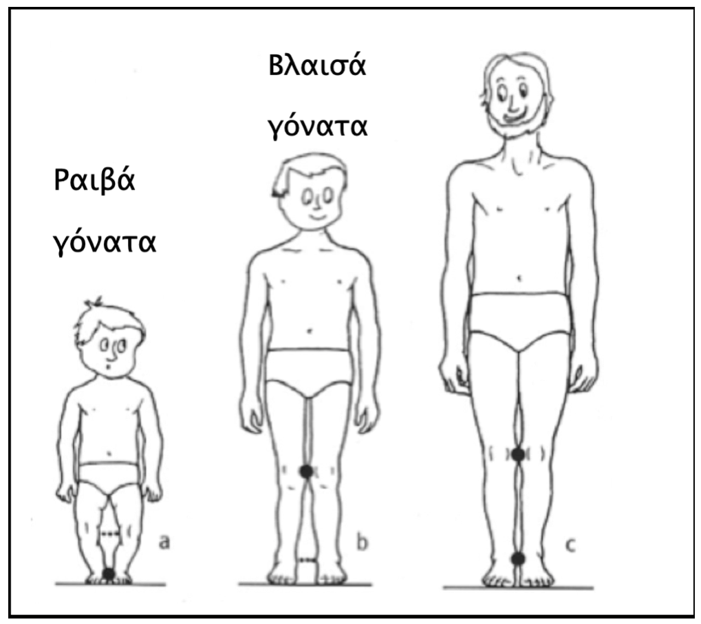 Βλαισογονία σε παιδιά: η βλαισογονία αποτελεί ένα „φυσιολογικό στάδιο“ που θα περάσουν τα πόδια των ποδιών, ειδικά στις ηλικίες μεταξύ 3-5 ετών. 