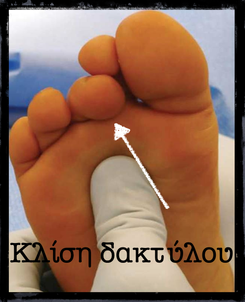 Εφίππευση δακτύλων. Το 3ο δάκτυλο μπαίνει κάτω από το 2ο.